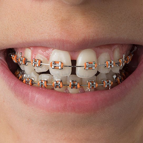 Don't Be Fooled By Braces Myths! - MyOrthodontist - MyOrthodontist -